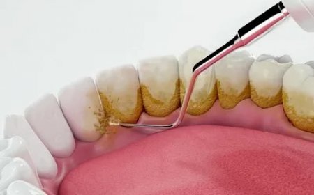 Teeth Scaling in Islamabad: Essential Dental Care for a Modern Lifestyle
