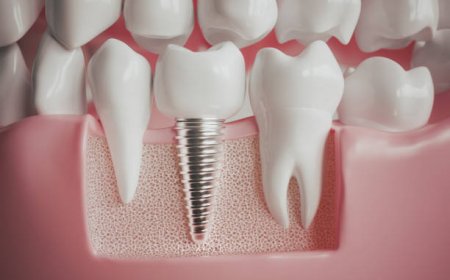 How Full-Mouth Dental Implants Can Transform Your Smile