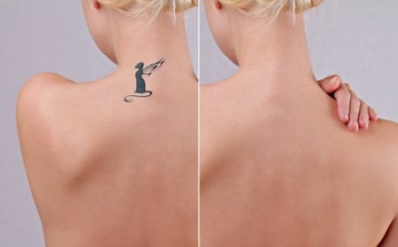 What to Expect During Your First Tattoo Removal Session in Islamabad