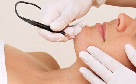 Top Options for Electrolysis Surgery in Riyadh