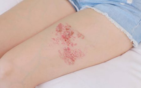 الحزام الناري بالصور: تعرف على الأعراض المبكرة