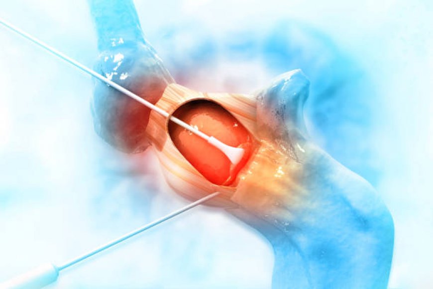 Laser Treatment of Hemorrhoids in Riyadh: What to Expect