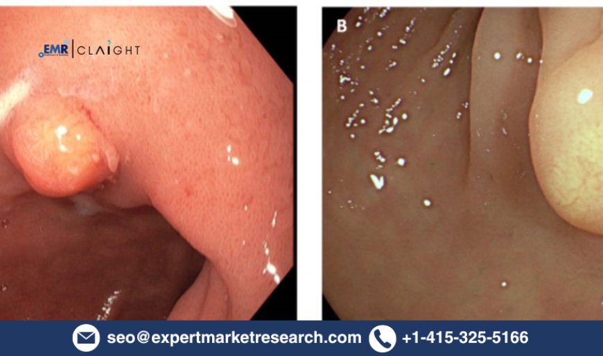 Gastric Neuroendocrine Tumor Market – Global Industry Size, Trends & Forecast to 2034