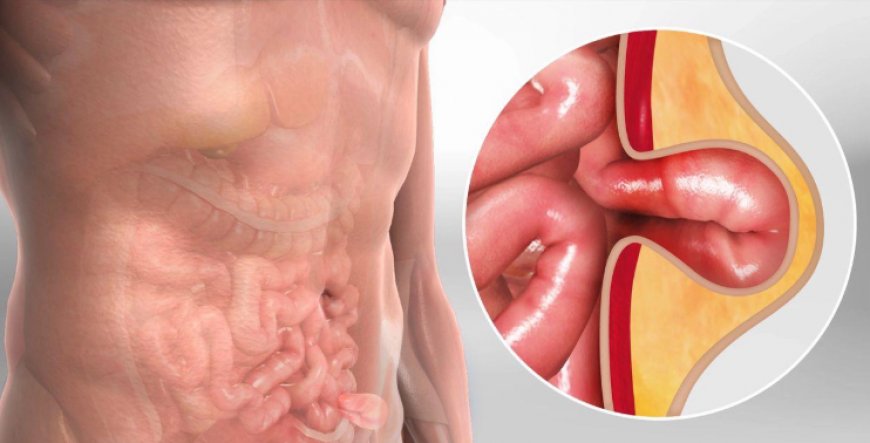 How to Stop a Hernia from Growing?