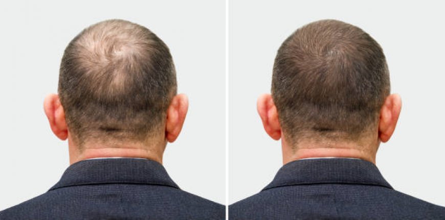 هل زراعة الشعر في الرياض تناسب حالتك؟ اكتشف الآن