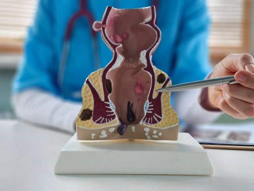 آراء وتجارب حقيقية عن علاج البواسير بالليزر في الرياض