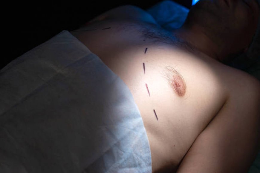 Quick Guide to Gynecomastia Surgery in Riyadh