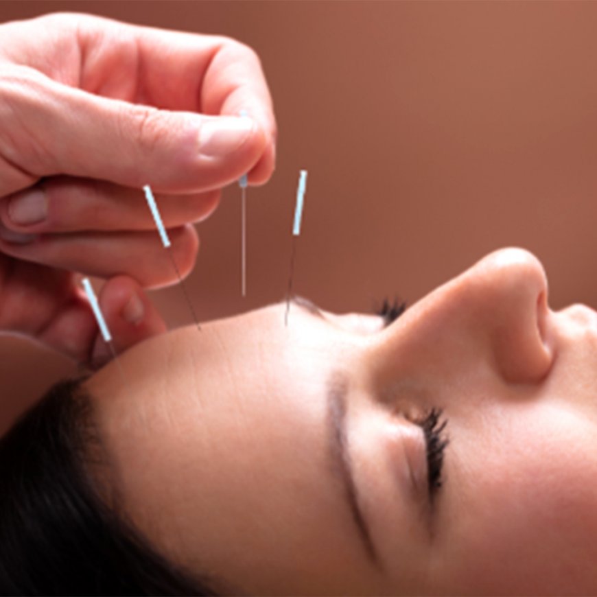 Beauty Benefits of Cosmetic Acupuncture: A Natural Alternative to Botox