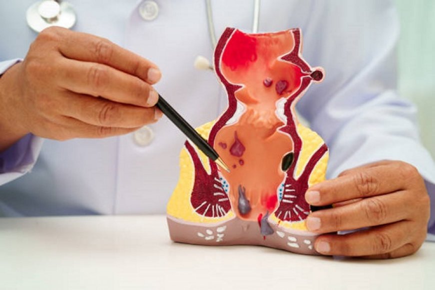 علاج البواسير بالليزر في الرياض.. نتائج تدوم طويلاً