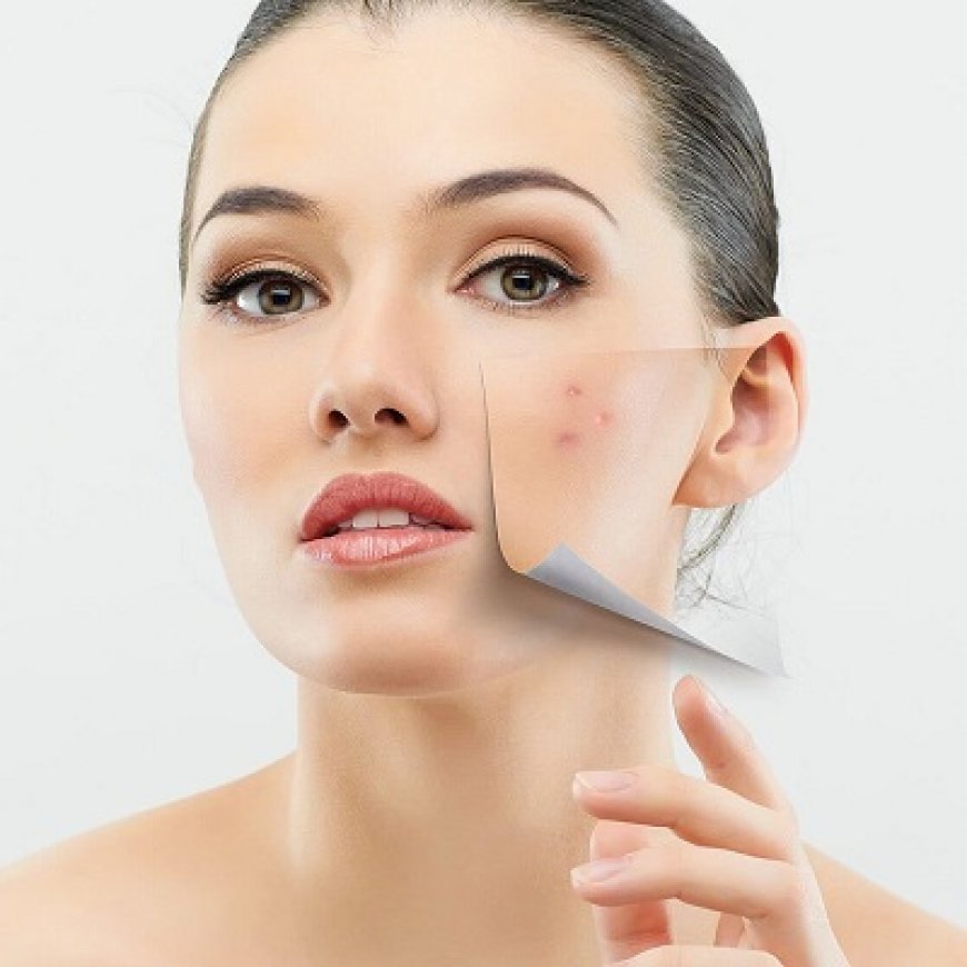 Can Acne Scars Be Fully Removed? Expert Opinions from Islamabad