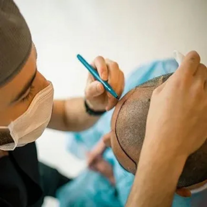 Hair Transplant for Crown Baldness: Solutions in Islamabad