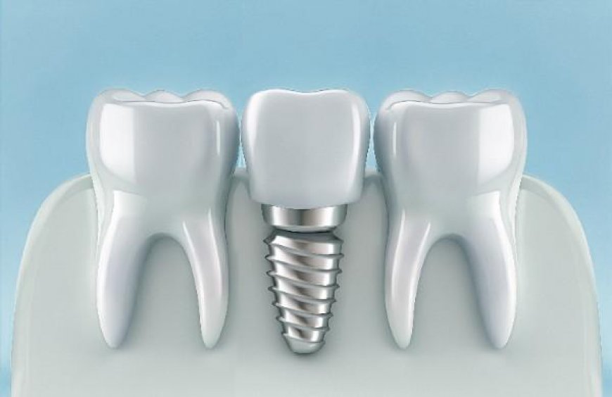 Permanent Fix for Multiple Missing Teeth with Implants