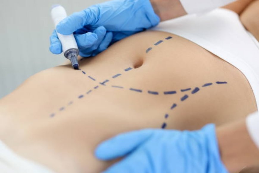 Why Tummy Tuck in Riyadh Is Popular Among Locals