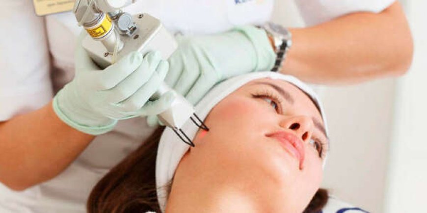 Fractional Laser for Hyperpigmentation