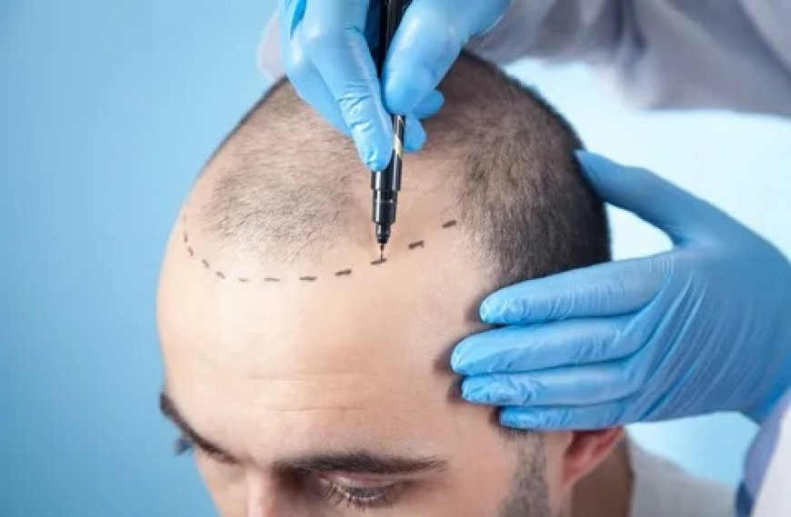 The Science Behind Hair Transplant Techniques