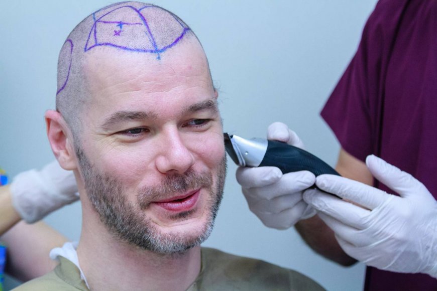 Hair Transplant for Female Pattern Baldness