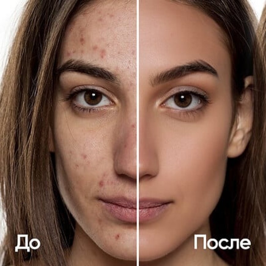 What Causes Acne and How to Prevent It