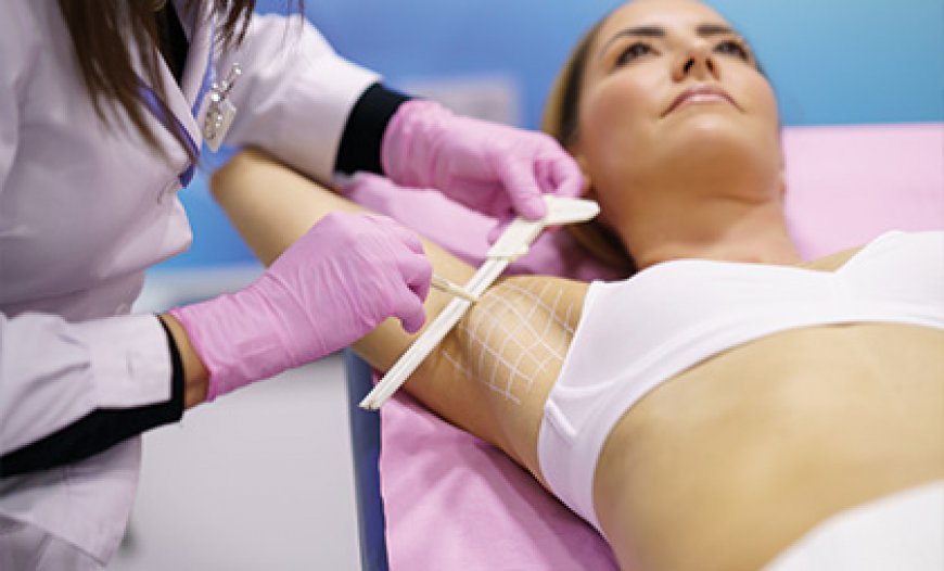 Dealing with Sweaty Underarms in Public? MiraDry Might Be the Fix