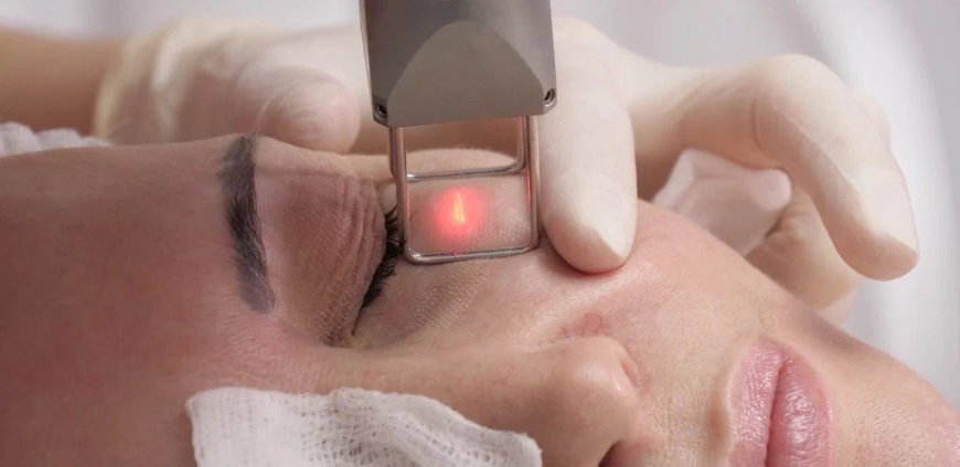 Fractional Laser: Melasma Solution