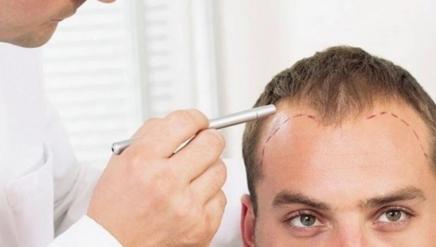 Diet and Nutrition for Hair Transplant Success