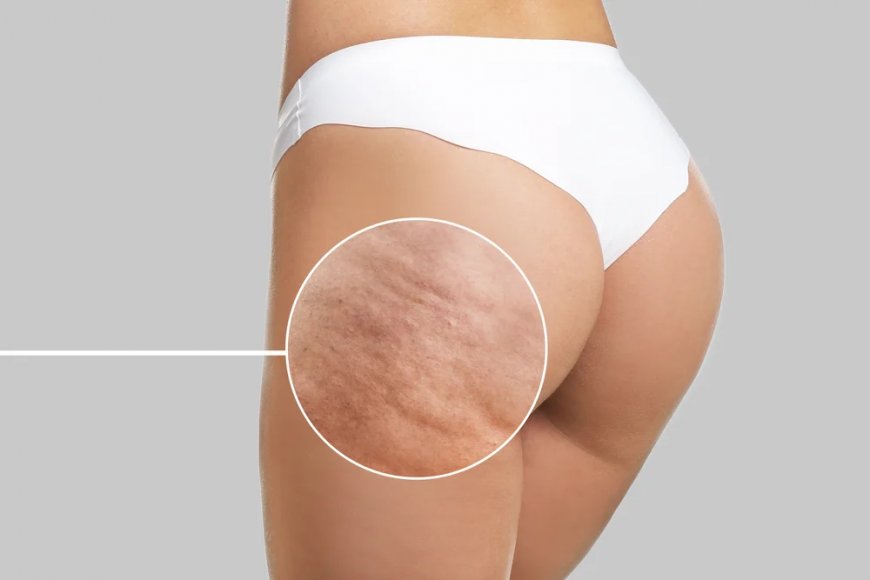 How Long Does It Take to See Results from Cellulite Treatments?