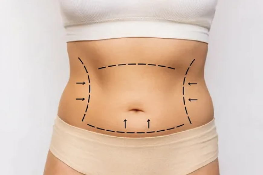 Effective Tummy Tuck in Riyadh Procedures