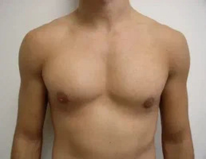Gynecomastia Surgery in Riyadh Costs & What’s Included