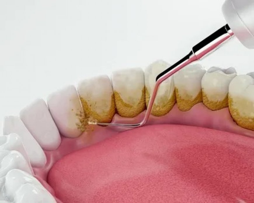 Teeth Scaling in Islamabad: Essential Dental Care for a Modern Lifestyle