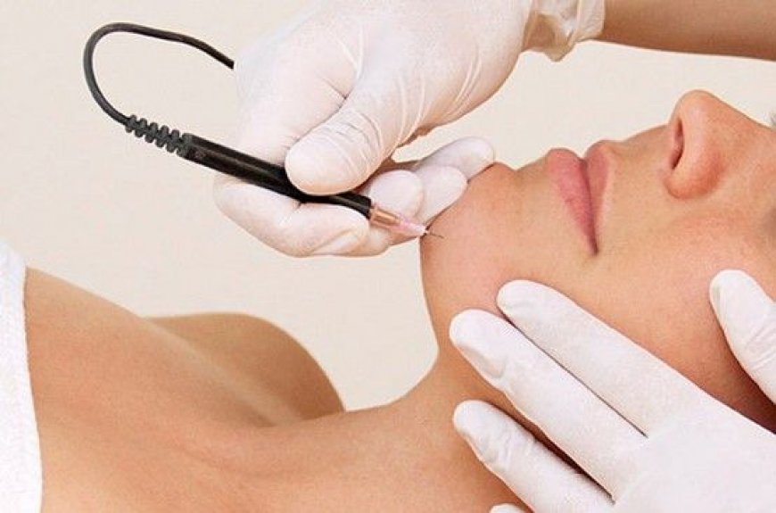 Top Options for Electrolysis Surgery in Riyadh
