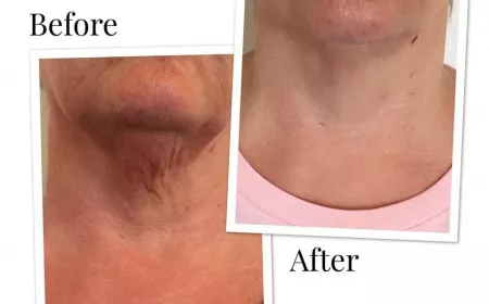 Seeing the Change: What Profhilo Before and After Photos Reveal