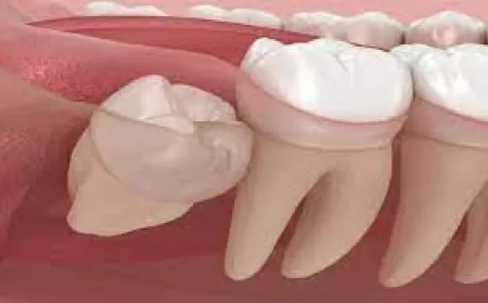 Choosing the Right Dentist for Wisdom Tooth Removal