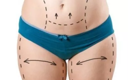 Is Obesity Surgery in Riyadh Right for You?