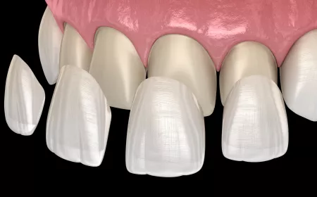 Transform Your Smile: Why Veneers in Lancaster Are a Game-Changer