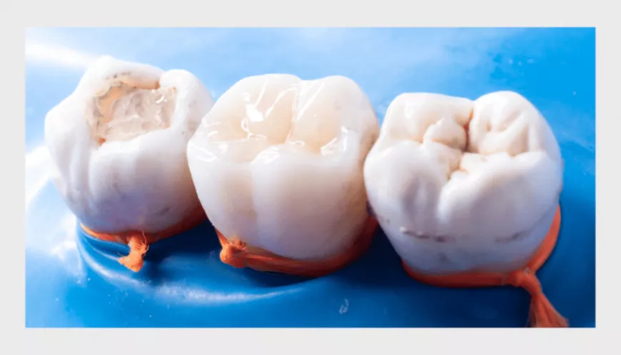 From Diagnosis to Solution: How Same Day Fillings Work