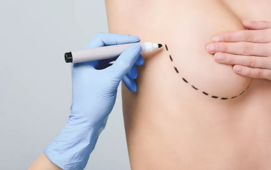 Can You Breastfeed After Getting Implants in Islamabad?