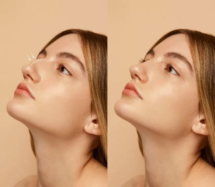 Top Results of Rhinoplasty Surgery in Riyadh