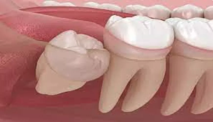 Choosing the Right Dentist for Wisdom Tooth Removal