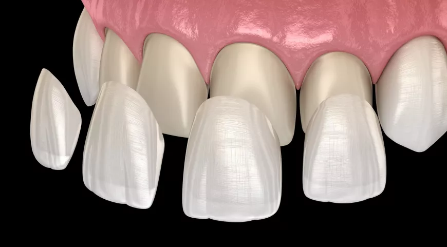 Transform Your Smile: Why Veneers in Lancaster Are a Game-Changer