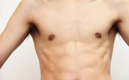 https://blogsgod.com/whats-the-recovery-like-for-gynecomastia-in-riyadh/