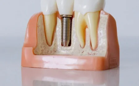 Dental Implants to Regain Your Confident Smile