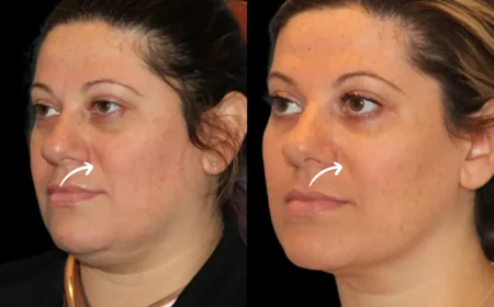 Sculptra Skin Upgrade by Best Plastic Surgeon in Dubai