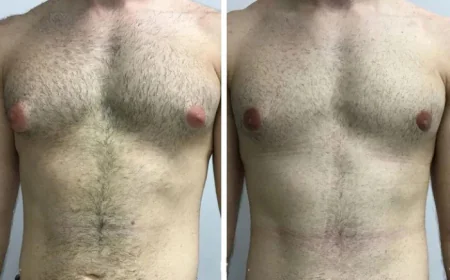 Recovery Tips After Surgery from the Best Gynecomastia Surgeon in Dubai
