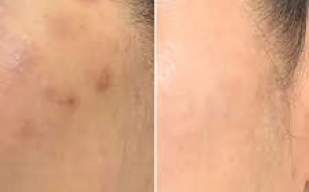 Rejuvenate Your Skin with Pico Laser Treatment in Islamabad