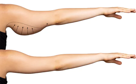 Understanding Surgical Arm Fat Reduction in Islamabad: Procedure and Benefits