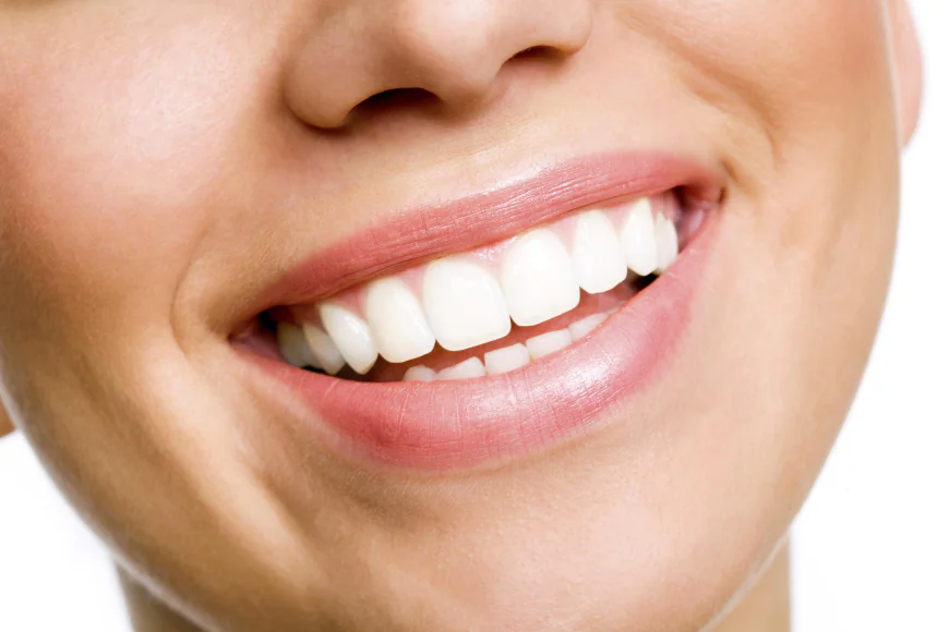 Is Teeth Whitening Safe?