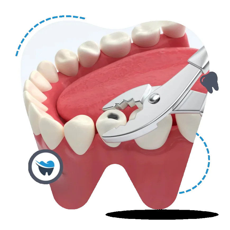 Root Canal vs. Teeth Extraction: A Clinical Comparison