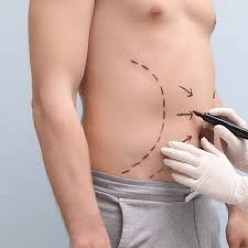 A Complete Guide to Liposuction in Islamabad