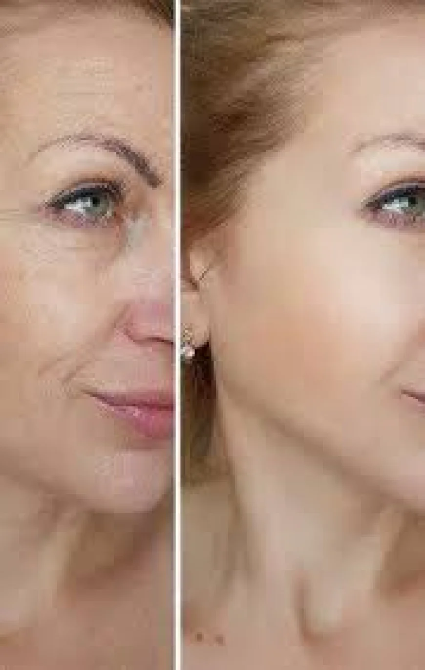 Tighten Without the Tuck: The Rise of Laser Skin Rejuvenation