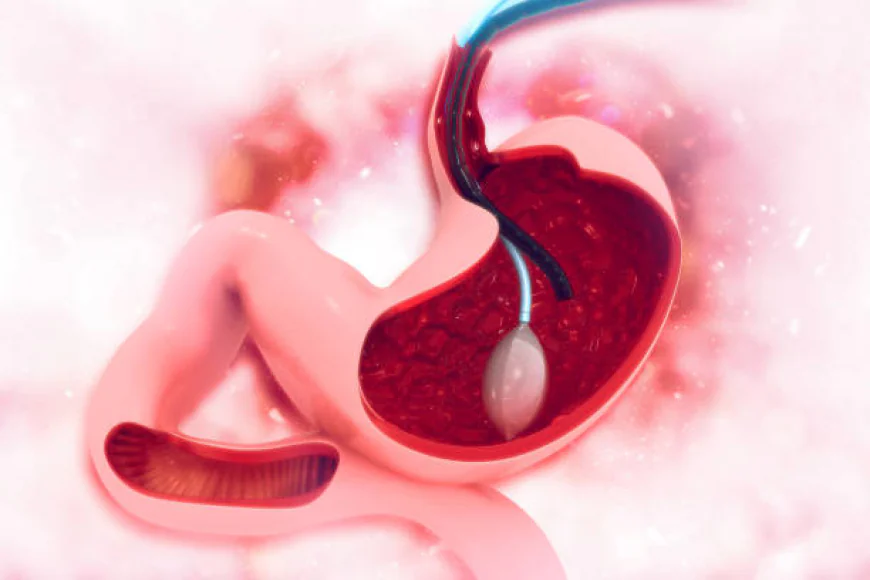 Riyadh: Adjustable Gastric Balloon Info?