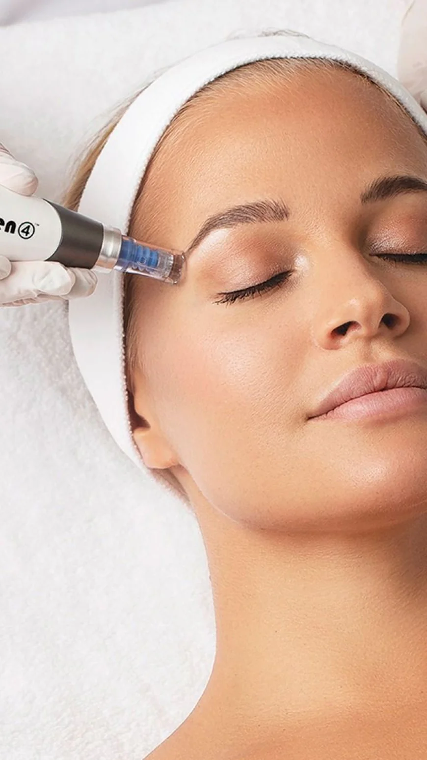 Derma Pen for Stretch Marks Treatment?